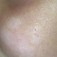 بیماری پوستی پیتریازیس آلبا چیست؟