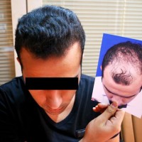 نکات مهم رایج در یک پیوند موی موفق