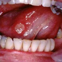 بیماری بهجت (Behcet's disease)