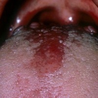 بیماری برفک دهانی (thrush) یا استوماتیت کاندیدایی