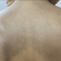 روش درمان بیماری ماکولار آمیلوئیدوز چیست؟