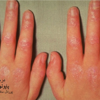 عکس پاپولهای گوترون در درماتومیوزیت