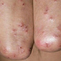 درماتیت هرپتی فرم (Dermatitis Herpetiformis)