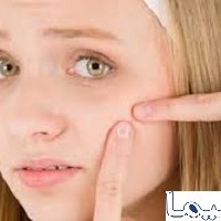 روش های درمان آکنه (غرور جوانی)