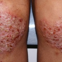 آشنایی با بیماری درماتیت آتوپیک و راههای درمان آن   (بخش اول)    