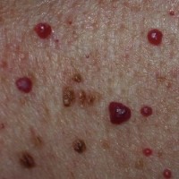 آیا خال قرمز قابل درمان است؟