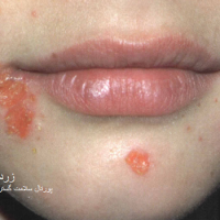 عکس زرد زخم