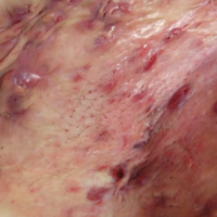 بیماری هیدرآدنیت چرکی (suppurative hidradenitis)