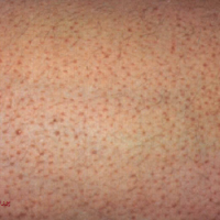 پوست پر مرغی (کراتوز پیلار)