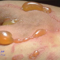 عکس فیتوفوتودرماتیت