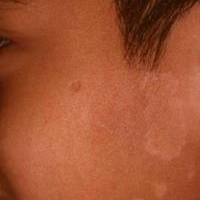 قارچ چند رنگی (Tinea versicolor) چیست؟