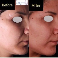 بهبود اسكار گوشه پلك و گونه با سابسيژن و ليزر، انجام شده توسط متخصص پوست دكتر علي رمضاني