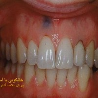 عکس خالکوبی با آمالگام