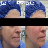 آراف فرکشنال و تزریق چربی صورت انجام شده توسط متخصص پوست دکتر محمد گلشنی
