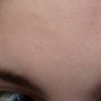 آیا امکان برطرف کردن خطوط ریز صورت بدون استفاده از روش بوتاکس وجود دارد؟