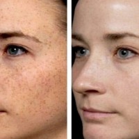 درمان برای کک و مک صورت