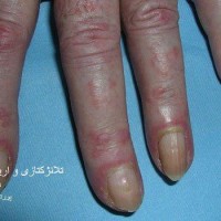 عکس بیماری درماتومیوزیت