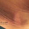 بیماری آکانتوزیس نگریکان (Acanthosis Nigricans)