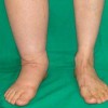 تورم لنفاوی Lymphedema