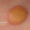 انواع ضایعات زرد رنگ پوست