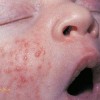 بیماریهای ایجاد کننده جوش های قرمز و چرکی در نوزادان