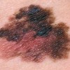 آشنایی با تومور بدخیم ملانوم (Melanoma)