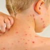 روش های درمان جای آبله مرغان چیست؟