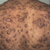 keloid