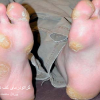 عکس کراتودرمای کف دست و پا