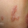 عکس سارکوئیدوز