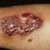 بیماری پیودرما گانگرنوزوم و راههای درمان آن