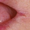 درباره ترک خوردگی گوشه لب (Angular cheilitis) بیشتر بدانیم 