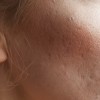 برای جای جوش چه لیزری پیشنهاد میکنید؟
