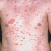 پیتیریازیس روزه آ (Pityriasis Rosea)