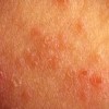 اگزما (حساسیت پوستی) چیست و چگونه ایجاد می شود؟