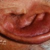 عکس پلی کندریت راجعه گوش