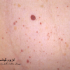 خال عروقی گیلاسی