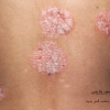 عکس پسوریازیس