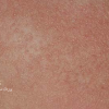 پوست پر مرغی (Keratosis pilaris)