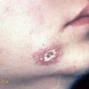 بیماری سل پوستی (skin tuberculosis)