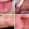 بیماری دست، پا و دهان (Hand, foot and mouth disease)