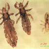 شپش سر (pediculosis capitis) 