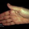 عکس بیماری ارف (ORF)