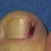 ناخن فرورفته در گوشت (ingrowing toe nail) 